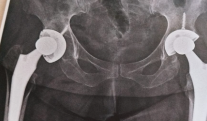 Cirurgia da Prótese de Quadril