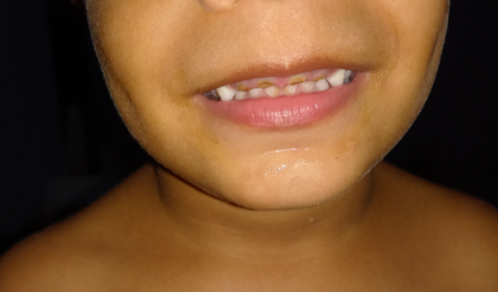  tratamento nos dentes do Enzo Gabriel