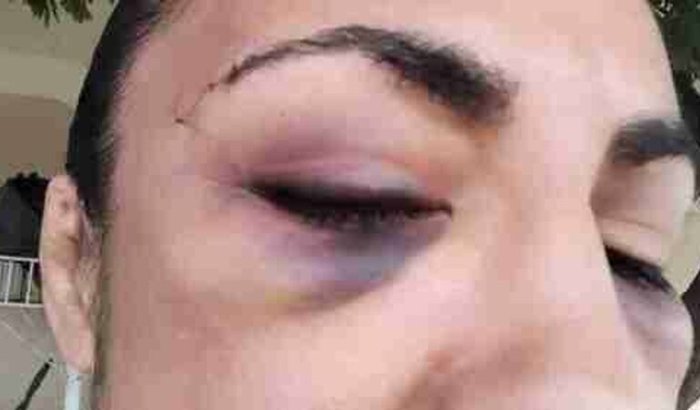 Cirurgia oftalmologica  da atleta de MMA Sidy Rocha