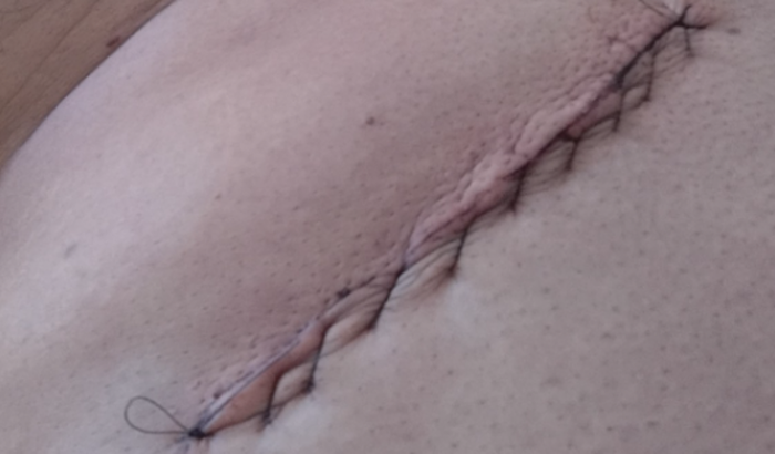 Estou desempregado fiz uma cirurgia 
