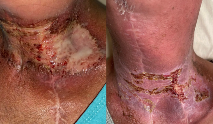 Odontologia para pacientes Oncológicos