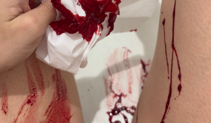 Ajude Larissa na Luta contra a Anemia Hemolítica