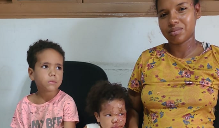 Familia Venezuelana (Queimaduras)