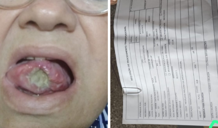 Luta contra câncer na lingua