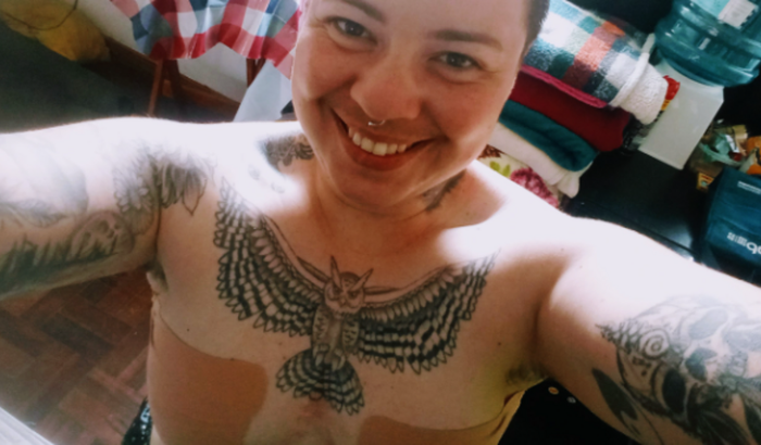 Mastectomia do Kaique