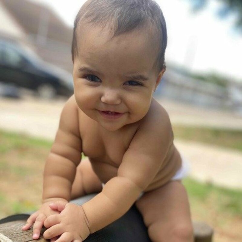 CIRURGIA GLAUCOMA MARIA ALICE