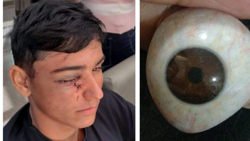 Prótese Ocular Marcus Ruiz