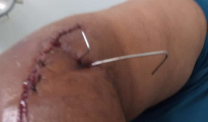 Ajude o Preto a se Recuperar do Acidente e Voltar ao Trabalho!