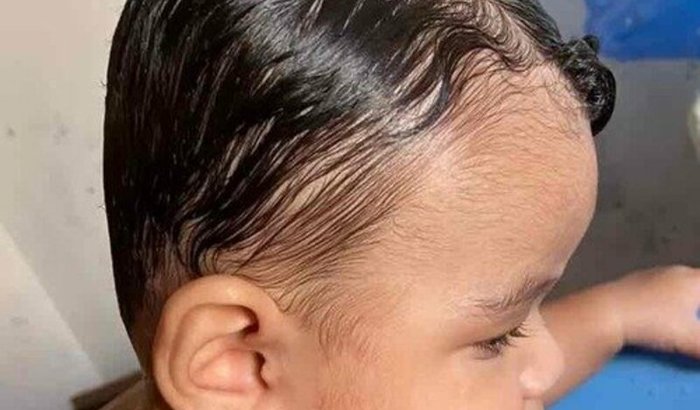 Ajude Heitor Miguel a conseguir sua órtese craniana