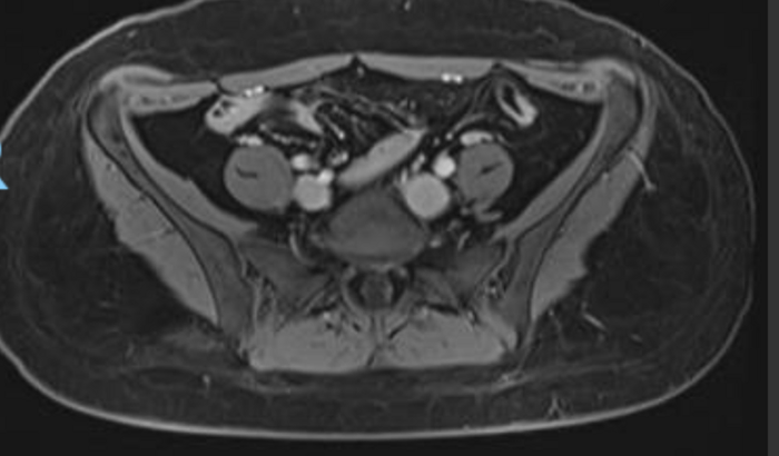 Cirurgia de Remoção de Tumor de ovário - Borderline