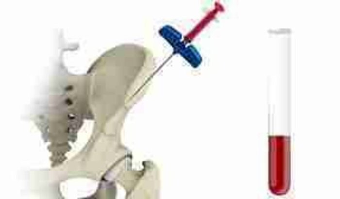 Tratamento com células-tronco BMAC