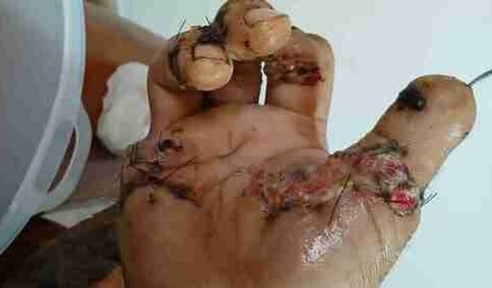 Ajuda para cirurgia de restauração de mão