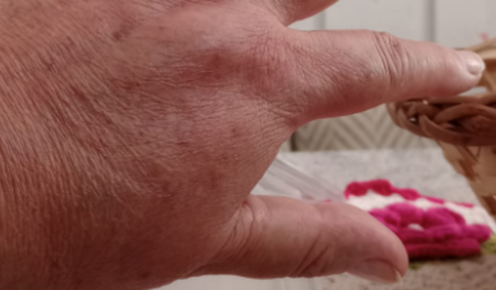 CIRURGIA - RIZARTROSE