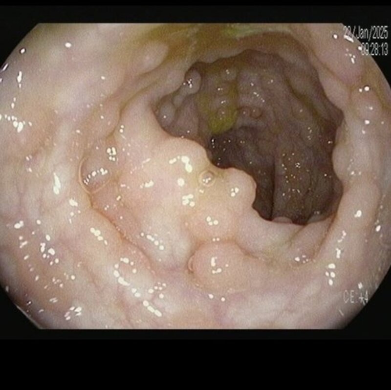 TODOS POR FABRINI - CIRURGIA URGENTE