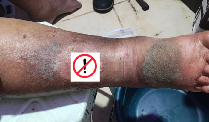 Ajuda de custos no tratamento da Erisipela