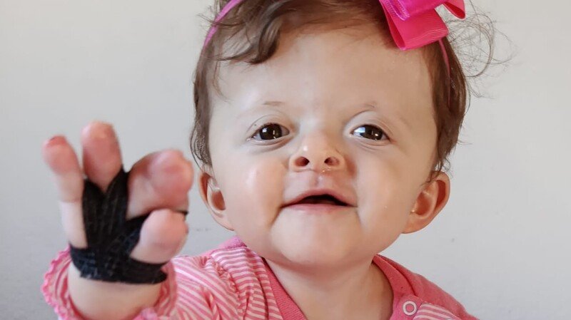  Kiara Sophia Sindrome de apert 