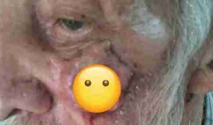 Ajuda para Cirurgia Urgente (Câncer na Face) Isaltino Moreira