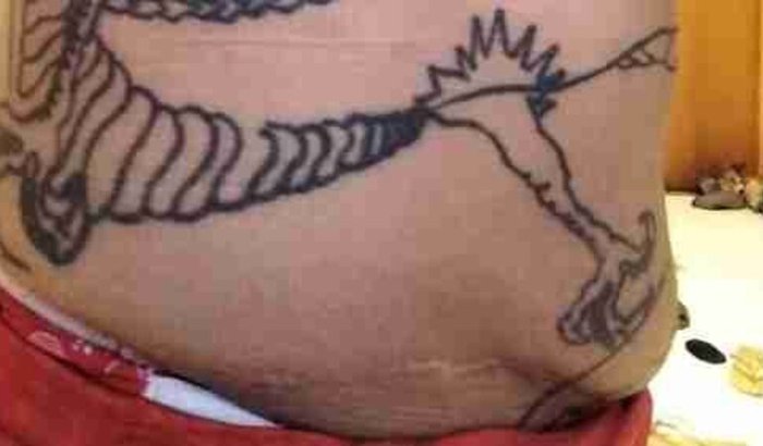 Tratamento de seroma encapsulado