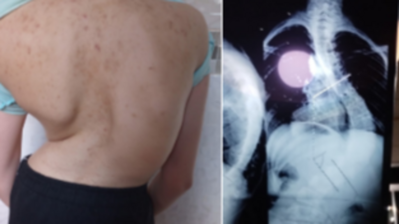 Ajude a Ana Letícia a realizar sua cirurgia na coluna