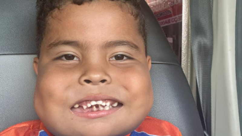 Todos pelo João Miguel! Doe e Ajude o João no tratamento de uma síndrome rara (Querubismo)