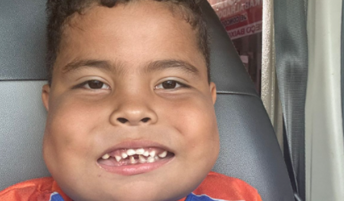 Todos pelo João Miguel! Doe e Ajude o João no tratamento de uma síndrome rara (Querubismo)