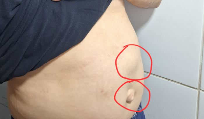 Cirurgia de hérnia abdominal do Mizael Churrasqueiro