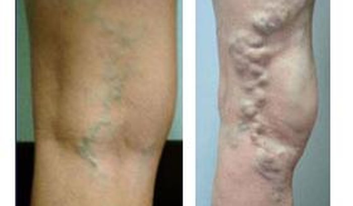 Flórida pernas da remoção veias nas de