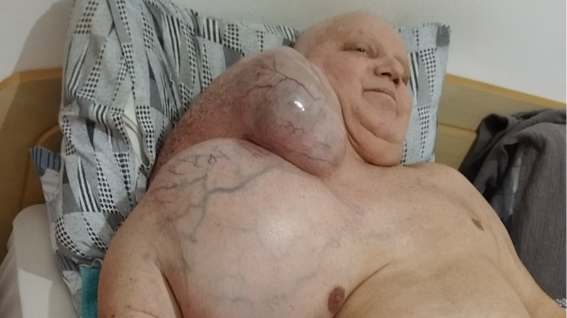 Ajude com o Câncer de Marcos (Condrossarcoma).