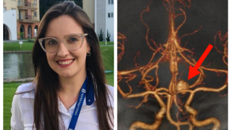 CIRURGIA CEREBRAL - Aneurisma dissecante