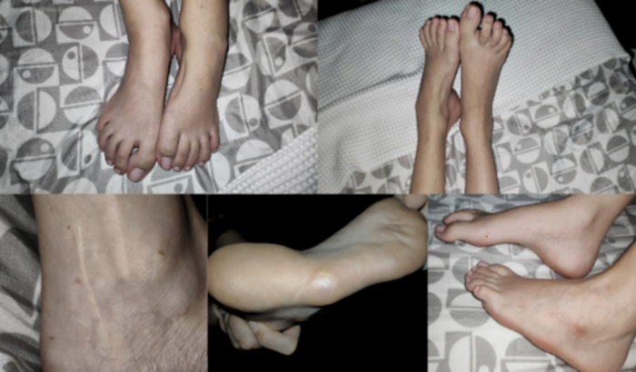 Ajuda Tratamento Polineuropatia Charcot-Marrie-Tooth