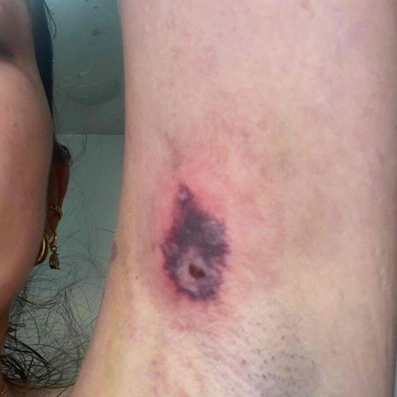 TRATAMENTO PARA A COLOCAÇÃO DE PORTOCATH 