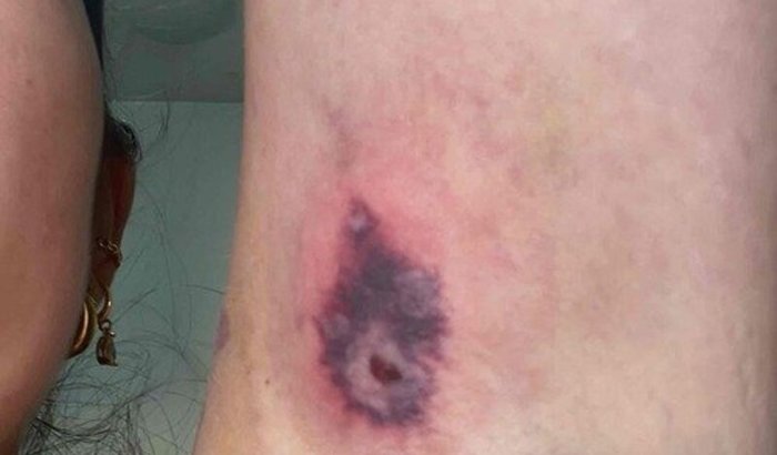 TRATAMENTO PARA A COLOCAÇÃO DE PORTOCATH