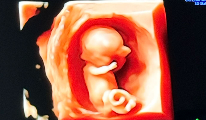 Ajude o Zay a vencer a Gastrosquise!