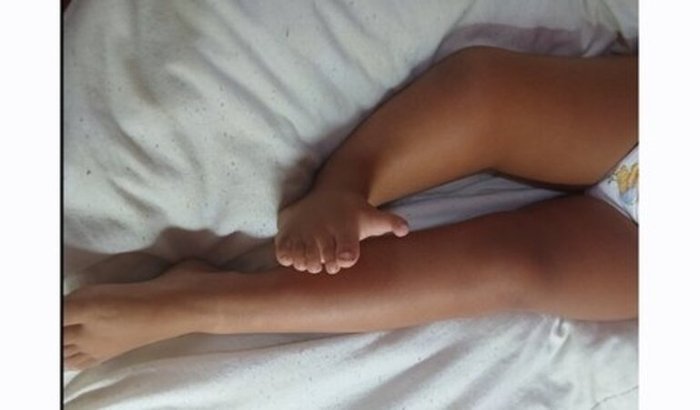 Caminhando com a Maya / Hemimelia Tibial