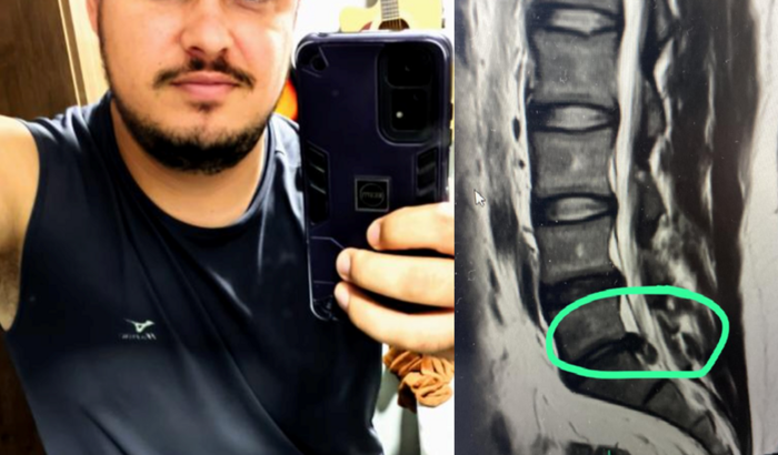 Ajuda para cirurgia da coluna