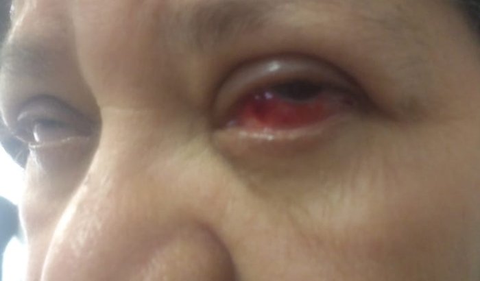 Cirurgia nos dois olhos para voltar Enxergar