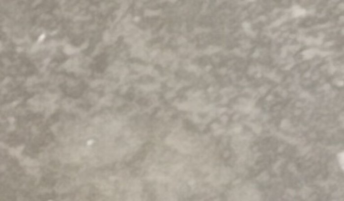 Fazer cirurgia de tibia antes q a infcsao "osseomielite" se espelha e eu possa perde ate mesmo a vida