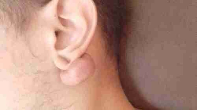 Retirada de uma quelóide 