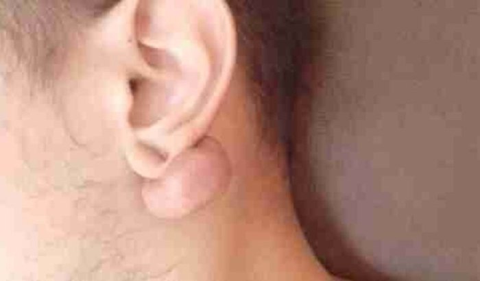 Retirada de uma quelóide 