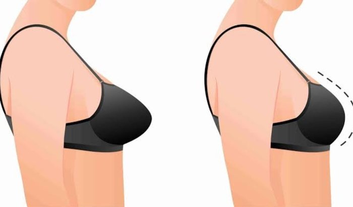 Mamoplastia Redutora