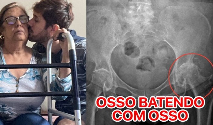 Cida: Ossos batendo! Lúpus. Prótese de Quadril já!