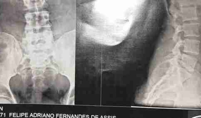 cirurgia para retirar um cisto pilonidal !