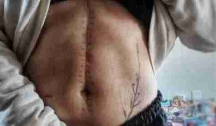 TRATAMENTO DE CÂNCER RARO