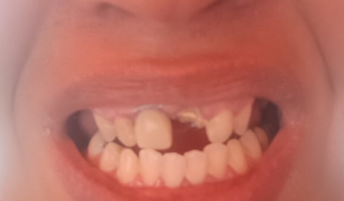 Ajuda concertar meu Dentes..