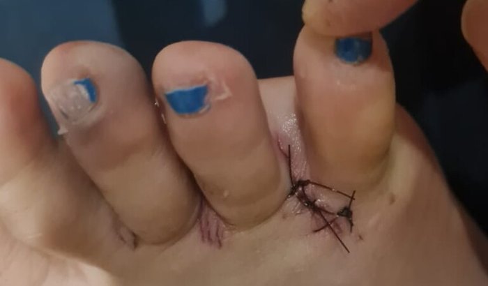 Cirurgia do meu pé direito