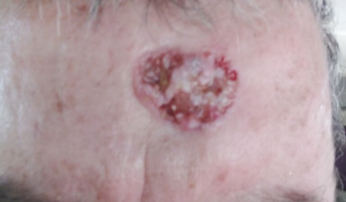 Ajuda para cirurgia de cancer