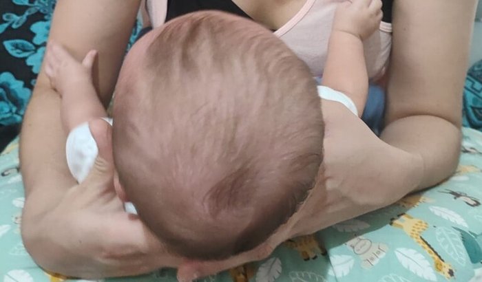 Órtese craniana do pequeno Rael 