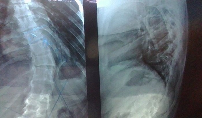 AJUDA PARA FAZER A CIRURGIA ARTRODESE