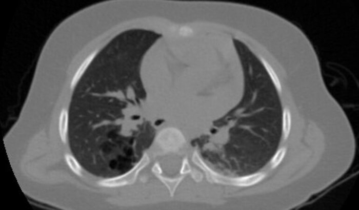 Ajuda para tratamento no pulmão ( bronquiectasia cística)