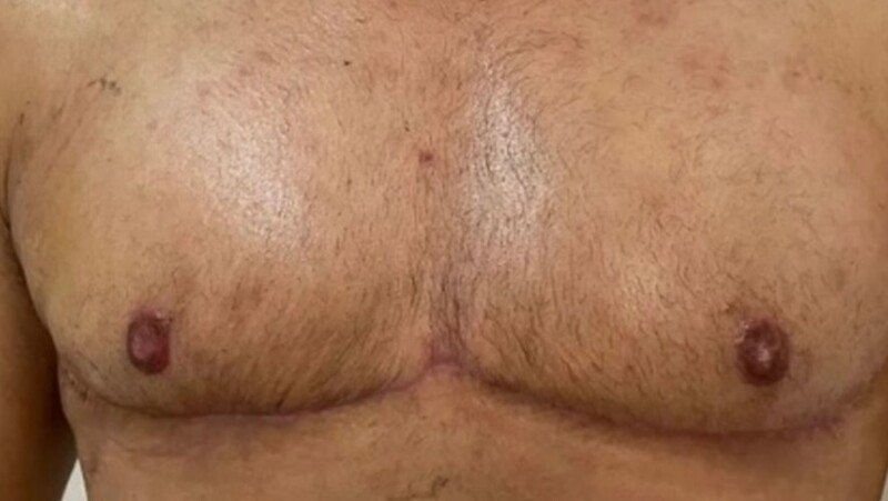 Realizando meu sonho de mastectomia 